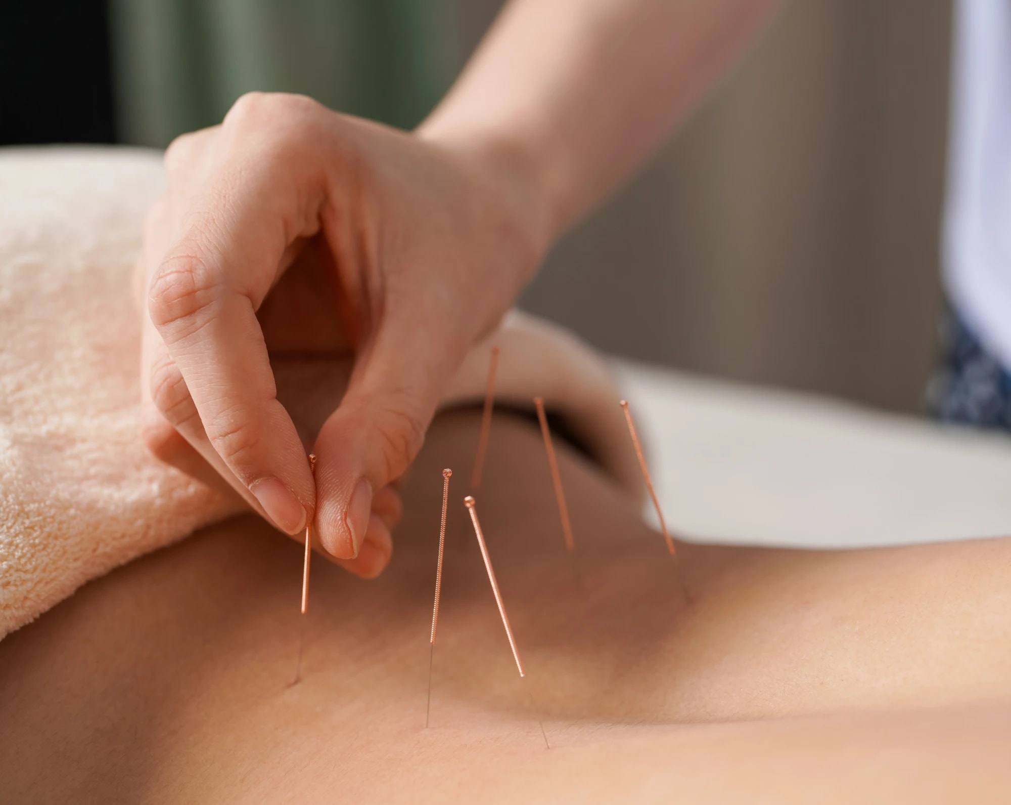 A practitioner gently placing fine acupuncture needles along the back