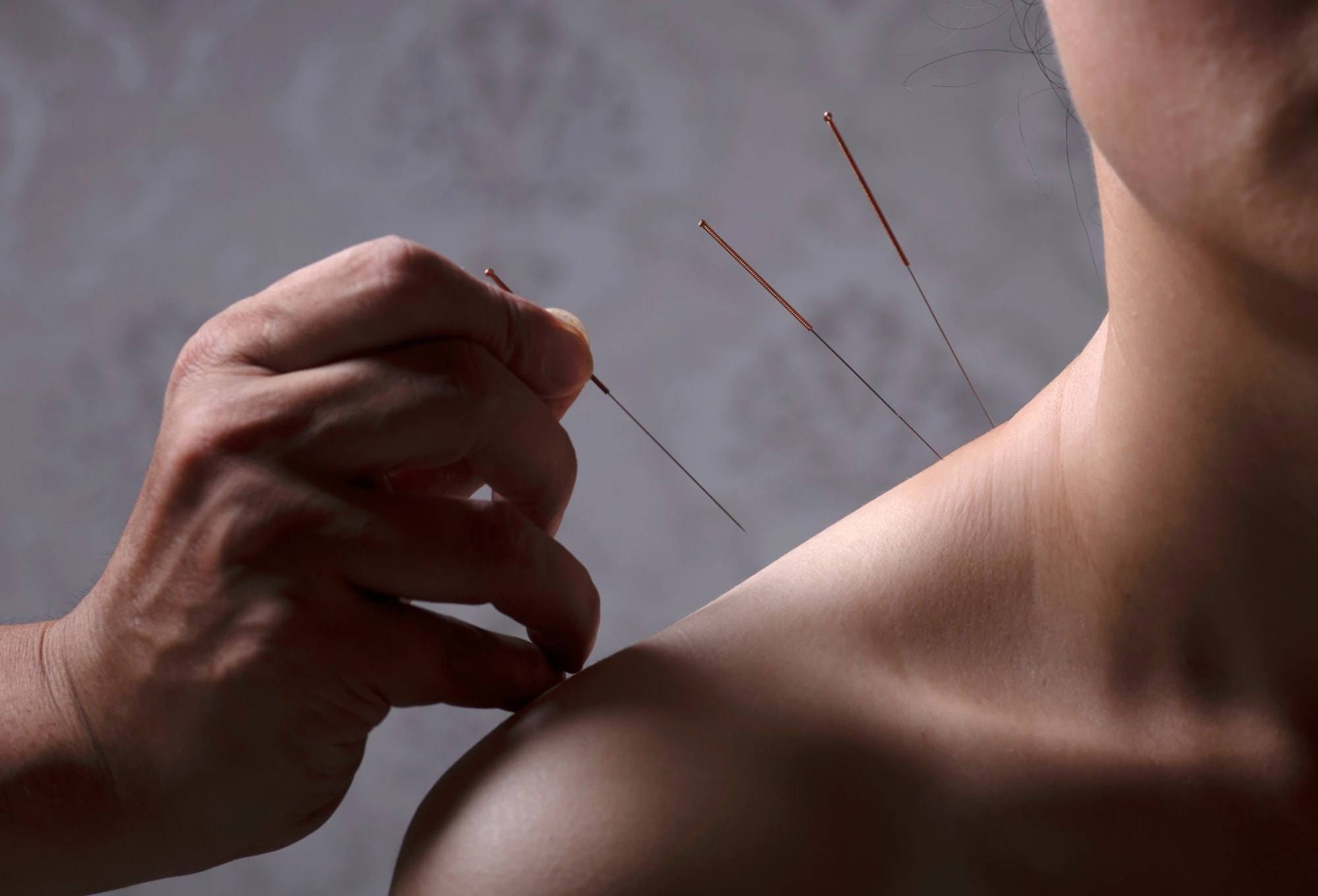 A practitioner placing acupuncture needles at the shoulder